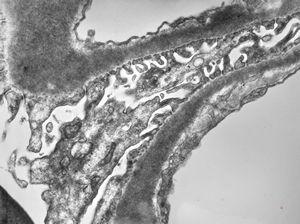 M,29y. | type II membranoproliferative glomerulonephritis (dense deposit disease) M,29y. | type II membranoproliferative glomerulonephritis (dense deposit disease)